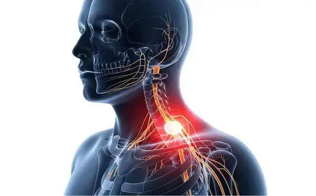Cervical Herniated Disc - Dallas TX