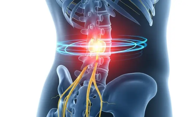Back and Sciatic Pain Degenerative Disc -Dallas Tx