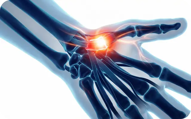 De Quervain Tenosynovitis Wrist Treatment Dallas TX