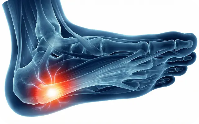 Plantar Fasciitis Foot Pain Treatment Dallas TX