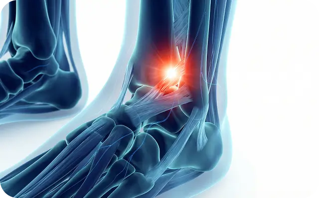 Syndesmotic Sprain Care Specialist Dallas TX