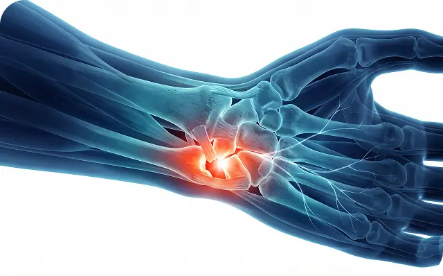 TFCC Wrist Pain Care Specialist Dallas TX