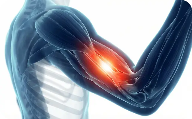 Bicep muscle pain illustration