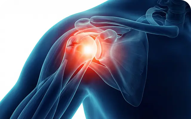 Rotator-Cuff-Tear